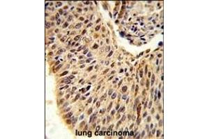 Formalin-fixed and paraffin-embedded human lung carcinoma reacted with GLIS1 Antibody (N-term), which was peroxidase-conjugated to the secondary antibody, followed by DAB staining. (GLIS1 抗体  (N-Term))