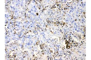 DHODH was detected in paraffin-embedded sections of human lung cancer tissues using rabbit anti- DHODH Antigen Affinity purified polyclonal antibody (Catalog # ) at 1 µg/mL. (DHODH 抗体  (N-Term))