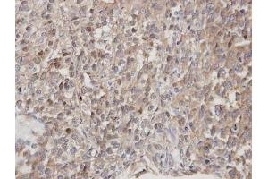 IHC-P Image Immunohistochemical analysis of paraffin-embedded human lung cancer, using DOCK 180 , antibody at 1:100 dilution. (DOCK1 抗体  (C-Term))