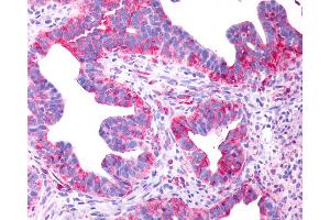 Anti-P2RY8 / P2Y8 antibody IHC of human Ovary, Carcinoma. (P2RY8 抗体  (Cytoplasmic Domain))