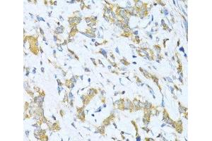 Immunohistochemistry of paraffin-embedded Human gastric cancer using KLHL42 Polyclonal Antibody at dilution of 1:100 (40x lens). (KLHDC5 抗体)