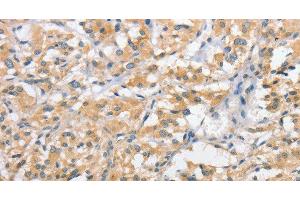 Immunohistochemistry of paraffin-embedded Human thyroid cancer using ATG10 Polyclonal Antibody at dilution of 1:60 (ATG10 抗体)