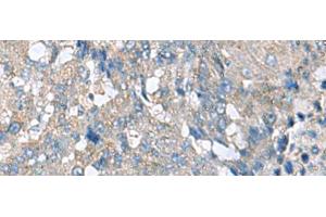 Immunohistochemistry of paraffin-embedded Human liver cancer tissue using HPCAL1 Polyclonal Antibody at dilution of 1:70(x200) (HPCAL1 抗体)