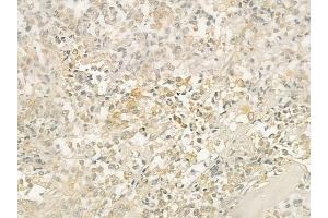 ABIN6254909 and ABIN6276368 at 1/100 staining human prostate carcinoma by IHC-P.