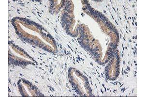 Immunohistochemical staining of paraffin-embedded Adenocarcinoma of Human colon tissue using anti-BAIAP2 mouse monoclonal antibody. (BAIAP2 抗体)