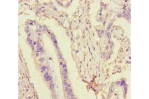 Immunohistochemistry of paraffin-embedded human pancreatic cancer using ABIN7173764 at dilution of 1:100 (TDRD3 抗体  (AA 401-651))