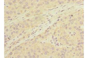 Immunohistochemistry of paraffin-embedded human liver cancer using ABIN7163378 at dilution of 1:100 (LHPP 抗体  (AA 1-270))