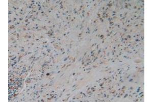 IHC-P analysis of Human Glioma Tissue, with DAB staining. (Gelsolin 抗体  (AA 577-771))