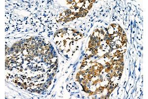 ABIN6258195 and ABIN6276040 at 1/100 staining Human esophageal cancer by IHC-P. (GPR87 抗体  (Internal Region))