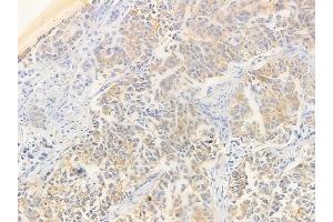 ABIN6262332 and ABIN6266483 at 1/100 staining human lung squamous cell carcinoma by IHC-P.