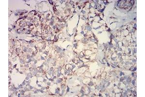 Immunohistochemical analysis of paraffin-embedded bladder cancer tissues using IDH2 mouse mAb with DAB staining. (IDH2 抗体  (AA 1-143))