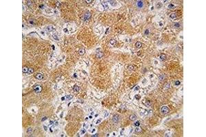 IHC analysis of FFPE human hepatocarcinoma tissue stained with APOA4 antibody (APOA4 抗体  (AA 49-79))