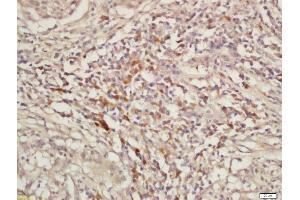 Formalin-fixed and paraffin embedded laryngeal cancer labeled with Rabbit Anti-KIF11 Polyclonal Antibody, Unconjugated  at 1:200 followed by conjugation to the secondary antibody and DAB staining (K11 (AA 351-450) 抗体)