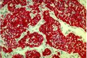 Renal cell carcinoma (MAb 2A4, cytokeratin 8, 18, 19) (Keratin 8/18/19 抗体)