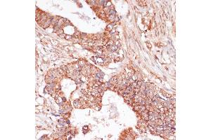 Immunohistochemistry of paraffin-embedded human colon carcinoma using MEK3 antibody (ABIN6130544, ABIN6143484, ABIN6143485 and ABIN6223650) at dilution of 1:100 (40x lens). (MAP2K3 抗体  (AA 1-170))