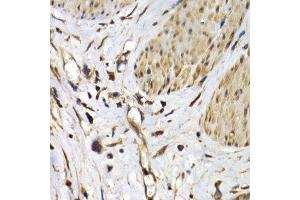 Immunohistochemistry of paraffin-embedded human stomach cancer using ISG15 antibody at dilution of 1:200 (400x lens). (ISG15 抗体)
