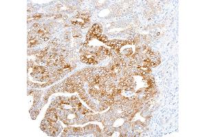 Immunohistochemistry (IHC) image for anti-Fatty Acid Synthase (FASN) (AA 2462-2511) antibody (ABIN7453707) (Fatty Acid Synthase 抗体  (AA 2462-2511))
