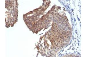 Immunohistochemical staining (Formalin-fixed paraffin-embedded sections) of human bladder carcinoma with KRT6 monoclonal antibody, clone KRT6/1702 . (KRT6A 抗体)