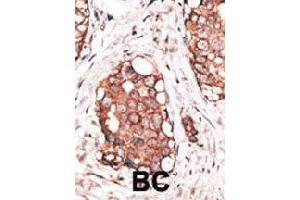 Formalin-fixed and paraffin-embedded human cancer tissue reacted with the HPCAL1 polyclonal antibody  , which was peroxidase-conjugated to the secondary antibody, followed by AEC staining. (HPCAL1 抗体  (N-Term))