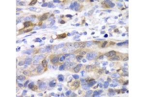 Immunohistochemistry of paraffin-embedded Human gastric cancer using UBE2C Polyclonal Antibody at dilution of 1:100 (40x lens). (UBE2C 抗体)