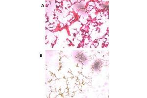 HE staining of frozen human ovarian cancer tissue reacted with the primary antibody at a 1:250 dilution. (UCHL5 抗体  (N-Term))