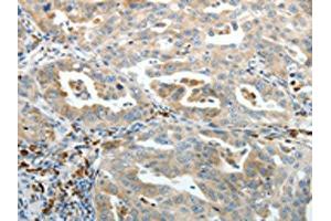 The image on the left is immunohistochemistry of paraffin-embedded Human ovarian cancer tissue using (PTEN Antibody) at dilution 1/20, on the right is treated with synthetic peptide. (PTEN 抗体)