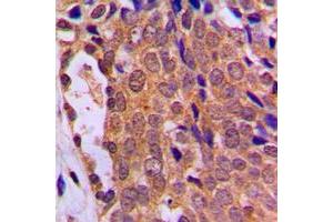 Immunohistochemical analysis of FOXO4 staining in human breast cancer formalin fixed paraffin embedded tissue section. (FOXO4 抗体  (Center))