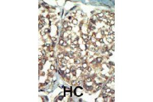 Formalin-fixed and paraffin-embedded human hepatocellular carcinoma tissue reacted with PI4K2B polyclonal antibody  , which was peroxidase-conjugated to the secondary antibody, followed by AEC staining. (PI4K2B 抗体  (C-Term))