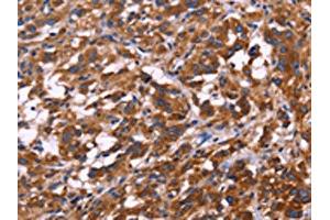 The image on the left is immunohistochemistry of paraffin-embedded Human thyroid cancer tissue using ABIN7129993(KIR2DL3/KIR2DL1/KIR2DL4/KIR2DS4 Antibody) at dilution 1/30, on the right is treated with fusion protein.