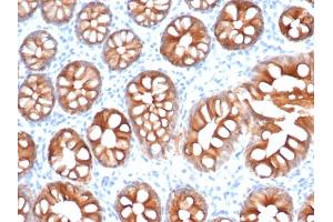 Formalin-fixed, paraffin-embedded human colon carcinoma stained with EpCAM Recombinant Rabbit Monoclonal Antibody (EGP40/1555R). (Recombinant EpCAM 抗体  (N-Term))