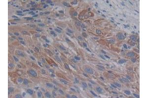 IHC-P analysis of Human Lung cancer Tissue, with DAB staining. (PCSK9 抗体  (AA 156-461))