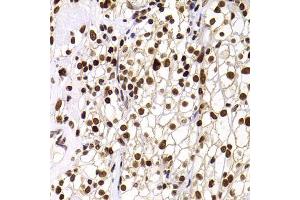 Immunohistochemistry of paraffin-embedded human kidney cancer using PHIP antibody (ABIN5974339) at dilution of 1/100 (40x lens). (PHIP 抗体)