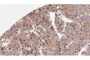 ABIN6266554 at 1/100 staining Human liver cancer tissue by IHC-P. (SLC2A3 抗体  (C-Term))