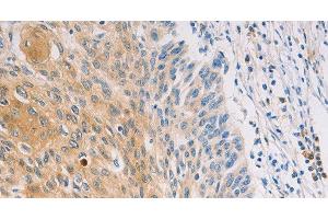 Immunohistochemistry of paraffin-embedded Human breast cancer tissue using MUC5B Polyclonal Antibody at dilution 1:30 (MUC5B 抗体)