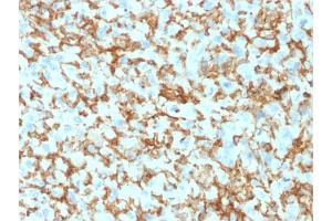 Formalin-fixed, paraffin-embedded human Histiocytoma stained with CD163 Mouse Monoclonal Antibody (M130/1210). (CD163 抗体  (AA 43-196))