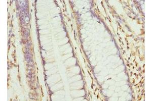 Immunohistochemistry of paraffin-embedded human colon cancer using ABIN7154797 at dilution of 1:100 (CLCN7 抗体  (AA 626-805))