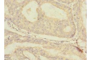 Immunohistochemistry of paraffin-embedded human endometrial cancer using ABIN7176671 at dilution of 1:100 (SLC3A1 抗体  (AA 328-507))