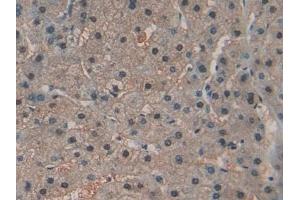 Detection of RNASE4 in Human Liver cancer Tissue using Polyclonal Antibody to Ribonuclease A4 (RNASE4)