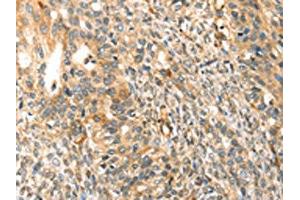 The image on the left is immunohistochemistry of paraffin-embedded Human breast cancer tissue using ABIN7192932(TRPV3 Antibody) at dilution 1/30, on the right is treated with synthetic peptide. (TRPV3 抗体)