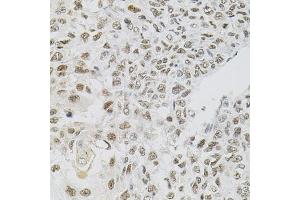 Immunohistochemistry of paraffin-embedded human lung cancer using FAF1 antibody (ABIN5975642) (40x lens). (FAF1 抗体)
