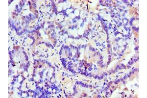 Immunohistochemistry of paraffin-embedded human lung cancer using ABIN7176599 at dilution of 1:100 (TRIM27 抗体  (AA 214-513))