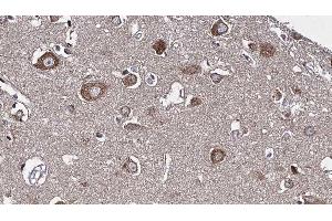 ABIN6277226 at 1/100 staining Human brain cancer tissue by IHC-P. (RIPK2 抗体  (N-Term))