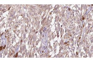 ABIN6276521 at 1/100 staining Human Melanoma tissue by IHC-P. (IL-18 抗体  (Internal Region))