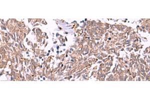 Immunohistochemistry of paraffin-embedded Human lung cancer tissue using IRX2 Polyclonal Antibody at dilution of 1:45(x200)