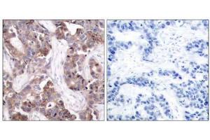 Immunohistochemical analysis of paraffin-embedded human breast carcinoma tissue using Stathmin 1 (phospho-Ser24) antibody (E011224). (Stathmin 1 抗体  (pSer24))