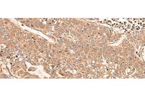 Immunohistochemistry of paraffin-embedded Human liver cancer tissue using LDAH Polyclonal Antibody at dilution of 1:55(x200) (LDAH/C2orf43 抗体)