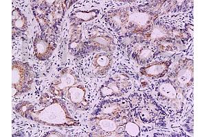Formalin-fixed and paraffin embedded human colon carcinoma labeled with Anti-Survivin Polyclonal Antibody, Unconjugated (ABIN670911) at 1:200, followed by conjugation to the secondary antibody and DAB staining (Survivin 抗体  (AA 85-142))