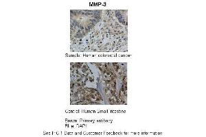 Researcher: Department of Pathology, Hospital de Carabineros de Chile, Santiago, ChileApplication: IHCSpecies+tissue/cell type: Control-Human small intestine, Sample-human colorectal cancer Primary Antibody dilution: 1:100Secondary Antibody: Biotinylated pig anti-rabbit+streptavidin-HRP (MMP3 抗体  (Middle Region))