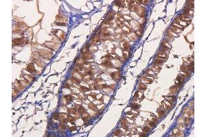 Immunohistochemical staining of human rectal carcinoma using anti-TAG72 antibody  Formalin fixed human rectal carcinoma slices were were stained with  at 5 µg/ml. (Recombinant TAG-72 (Satumomab Biosimilar) 抗体)