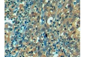Detection of HSPA1L in Human Endometrial cancer Tissue using Monoclonal Antibody to Heat Shock 70 kDa Protein 1 Like Protein (HSPA1L) (HSPA1L 抗体  (AA 1-641))